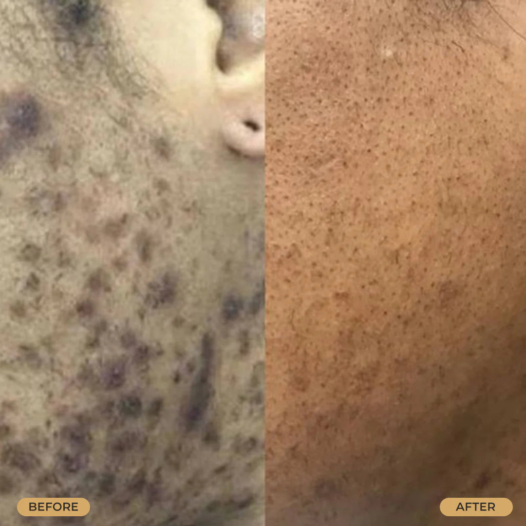 B&C Skin Tight Ingrown Hair & Razor Bump Creme