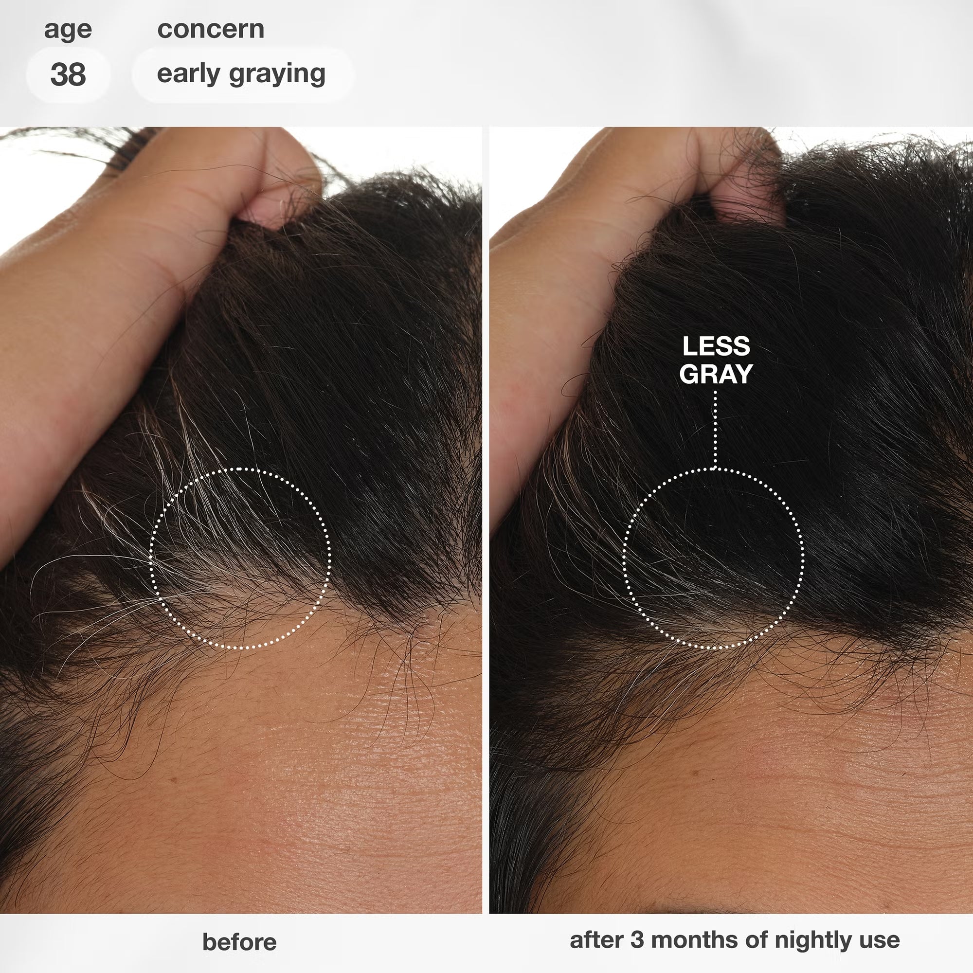 K18 Future IQ before and after results showing more hair growth and fewer grey hairs after 3 months of nightly use, age 38.
