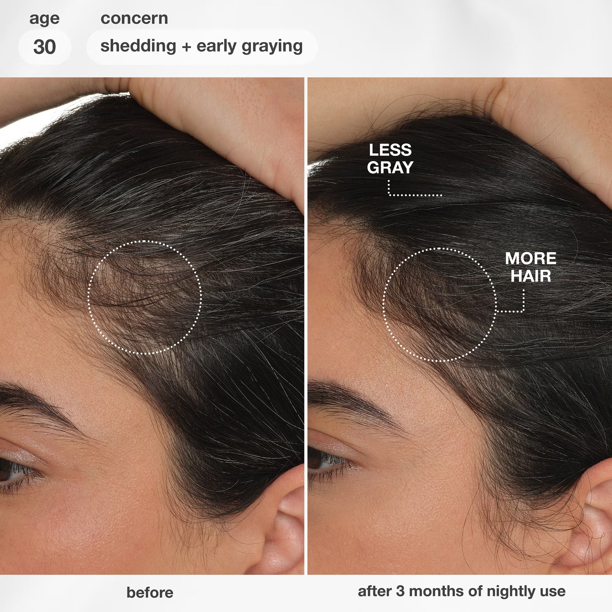K18 Future IQ before and after hair growth results showing reduced greys and improved hair density after 3 months, age 30.
