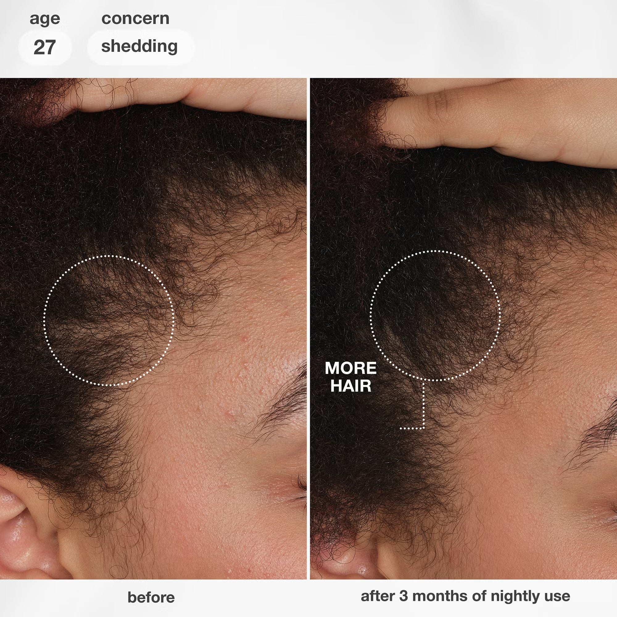K18 Future IQ before and after results on textured hair showing improved hair density after 3 months of nightly use.

