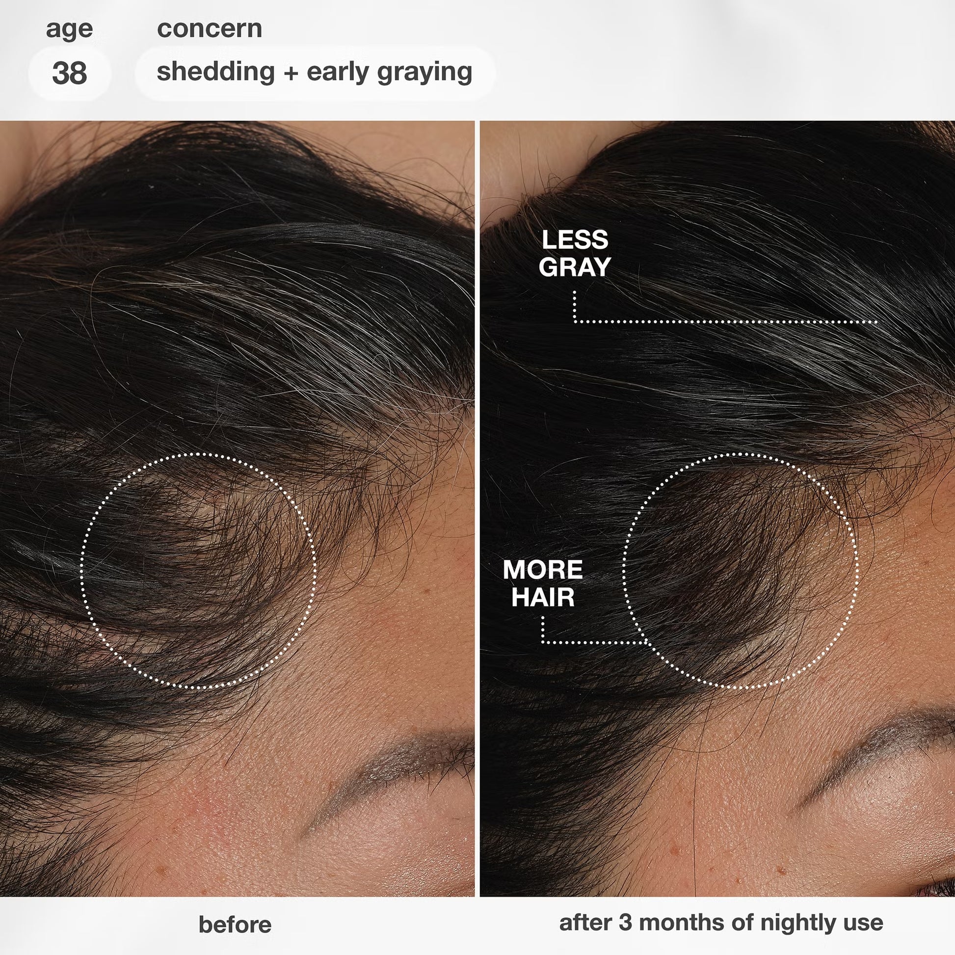 K18 Future IQ before and after results showing more hair growth and fewer grey hairs after 3 months of nightly use, age 38.

