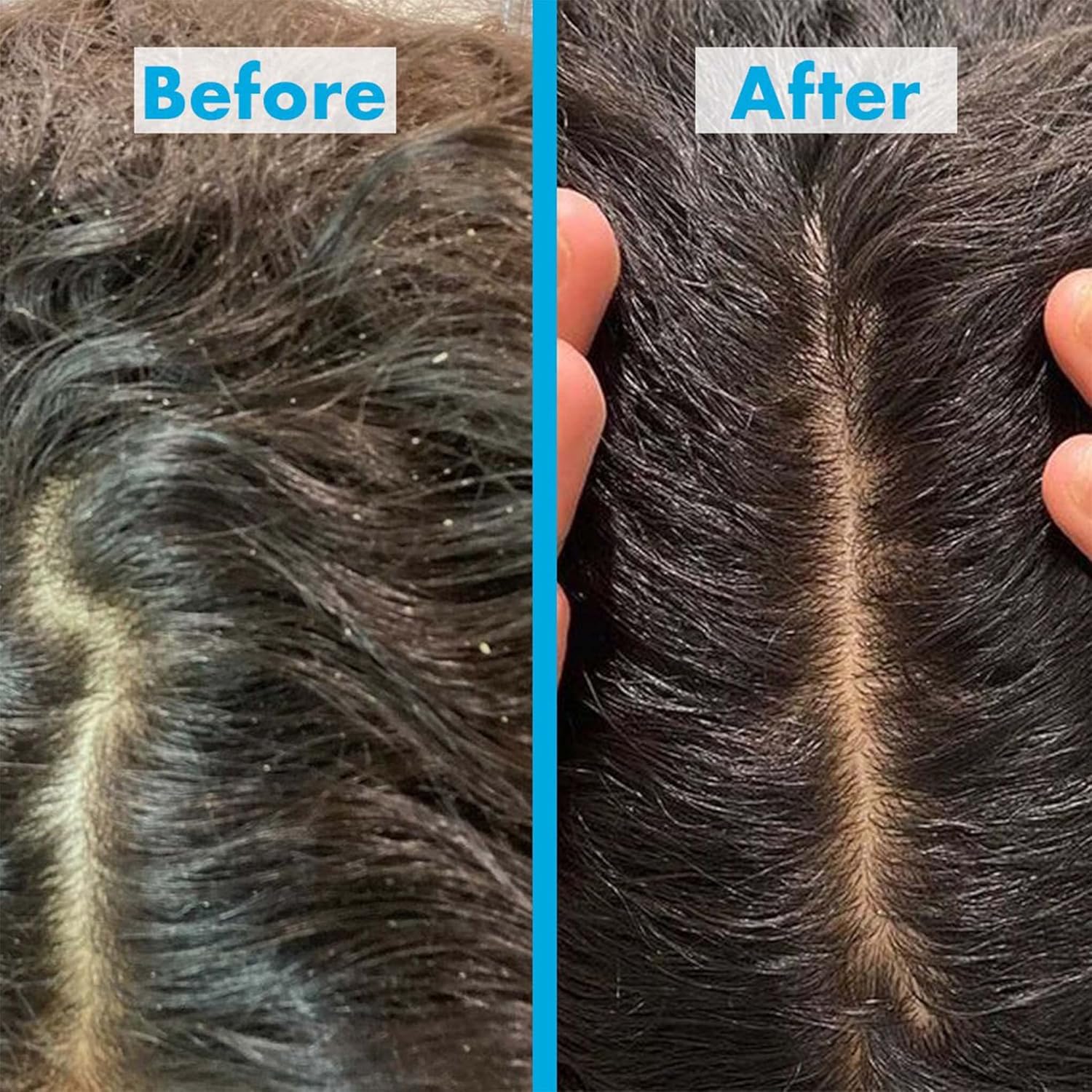 Before and after using Umberto Giannini Next Day Perfect Invisible Dry Shampoo 200ml dandruff removal results showing flaky scalp transformed into a clean, healthy scalp after using anti-dandruff hair care treatment.