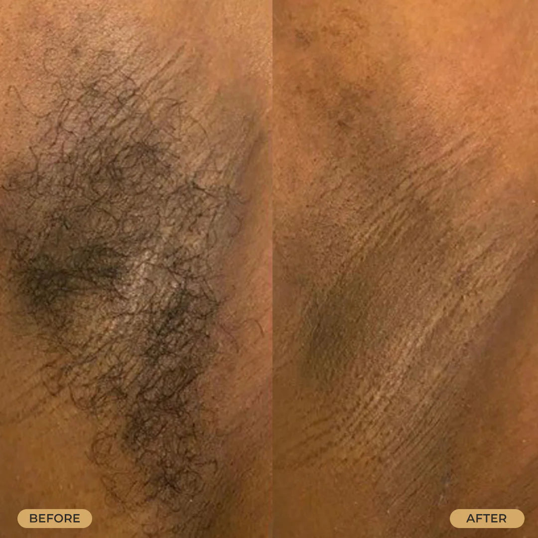B&amp;C Skin Tight Ingrown Hair &amp; Razor Bump Serum 4oz