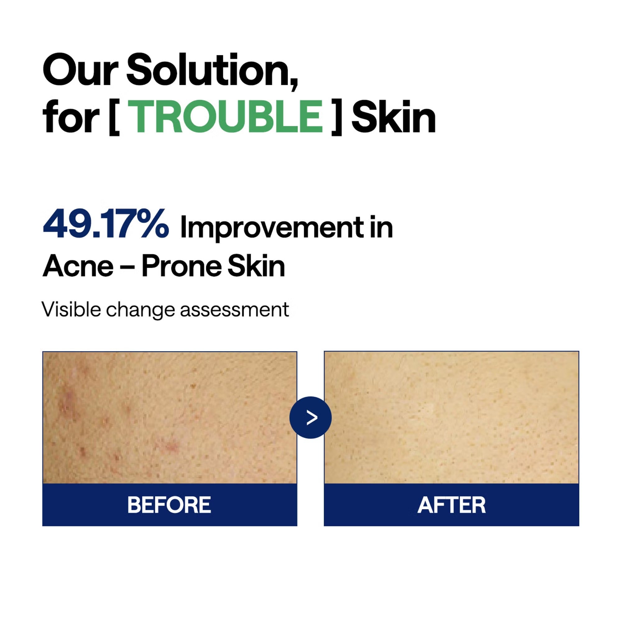 MEDIHEAL Teatree Trouble Pads 100 Pads improvement in skin